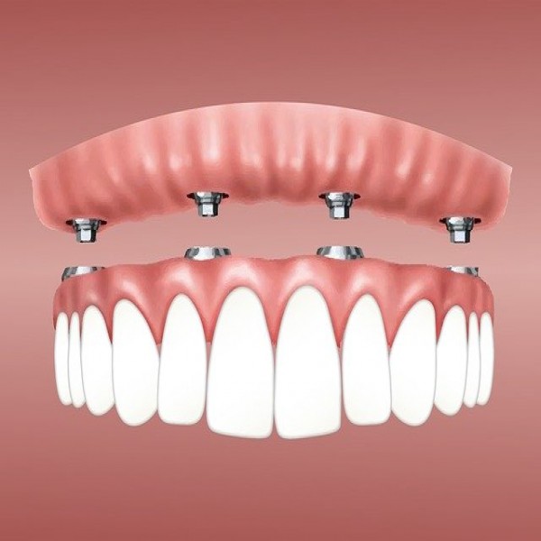 השתלות-שיניים-ממוחשבות-תוך-שימוש-בלייזר_1583849172.jpg